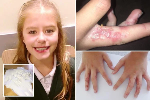 The hand of a girl effected by the chemicals in slime, causing chemical burns on her hand.